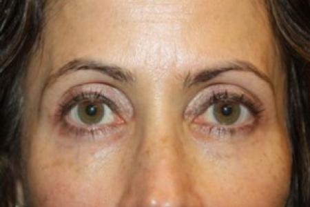 After image 1 Case #84886 - Upper LidBlepharoplasty & Brow Lift - 50 year old female