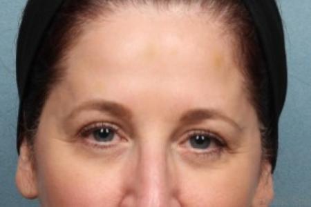 After Case #86806 - 55-64 year old woman treated with Botox