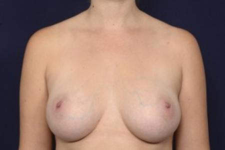 After image 1 Case #87536 - Breast Augmentation