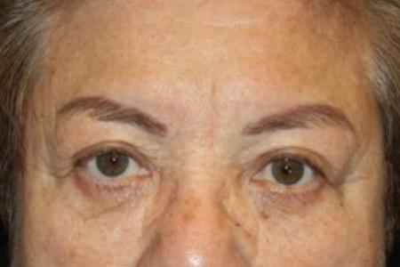 After image 1 Case #84706 - Blepharoplasty and Brow Lift - 78 year old female.