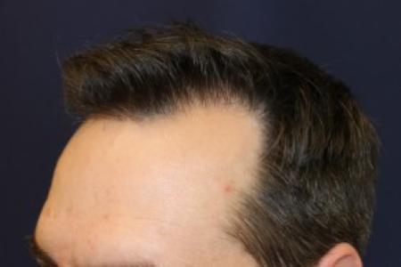 After image 3 Case #87376 - Hair Transplantation San Diego