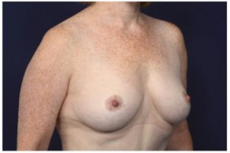 After image 2 Case #86281 - 49 year old woman treated with a Breast Lift