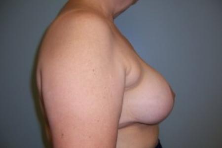 After image 3 Case #83166 - Breast Reduction 