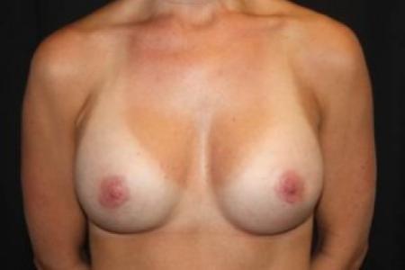 After image 1 Case #84871 - Breast Implant Exchange - 37 year old female