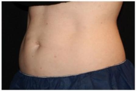 After Case #86356 - 40 yr old treated with nonsurgical fat reduction.