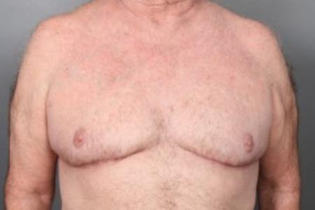 After image 1 Case #83756 - Gynecomastia Excision