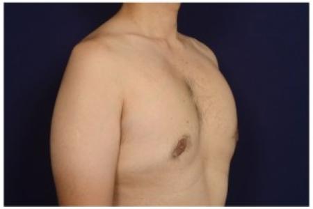 After image 2 Case #84501 - Gynecomastia