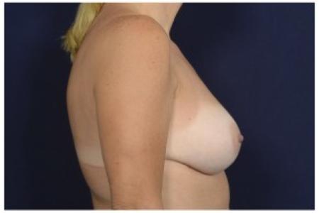After image 3 Case #86216 - 49 year old woman treated with Breast Augmentation