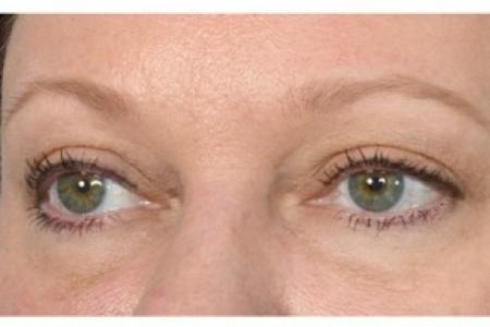 After image 3 Case #87121 - Eye Area Rejuvenation
