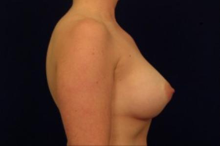 After image 3 Case #87666 - Breast Augmentation