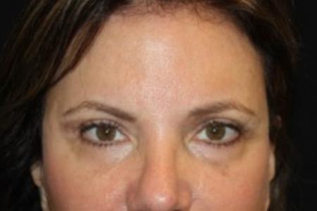After image 1 Case #84271 - Brow Lift- 60 year old female
