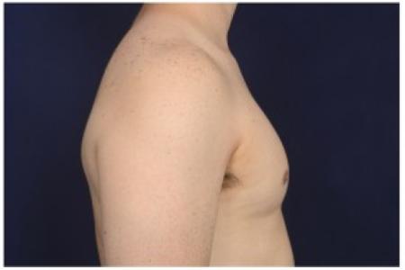 After image 3 Case #86211 - 32 year old man treated with Male Breast Reduction