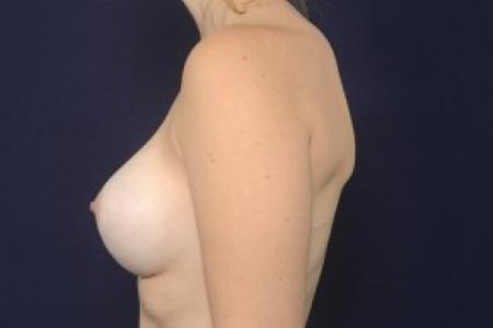 After image 3 Case #87526 - Breast Augmentation