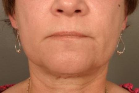 After image 1 Case #83581 - Neck Liposuction