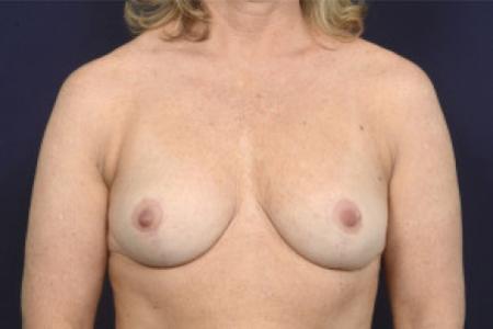 After image 1 Case #102601 - Breast Reduction