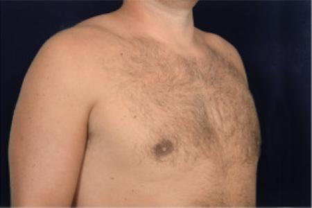 After image 2 Case #102446 - Gynecomastia