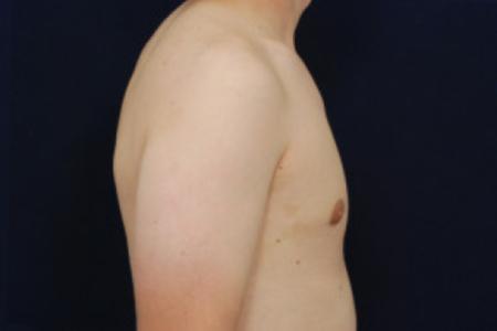 After image 3 Case #102656 - Gynecomastia