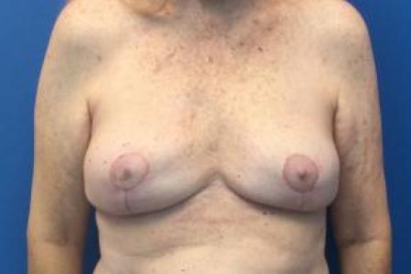 After image 1 Case #103266 - Bilateral Breast Implant Explantation for a 63 year old female
