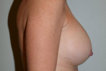 After image 2 Case #101601 - Breast Augmentation