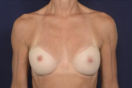 After image 1 Case #102566 - Breast Augmentation