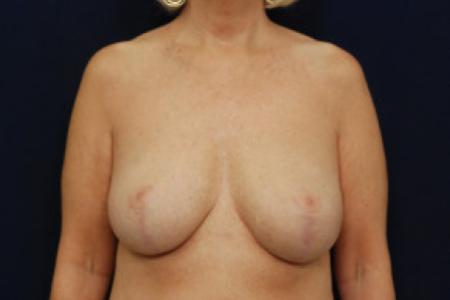 After image 1 Case #102671 - Breast Reduction