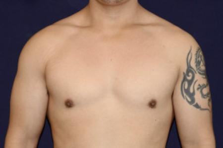 After image 1 Case #102731 - Gynecomastia