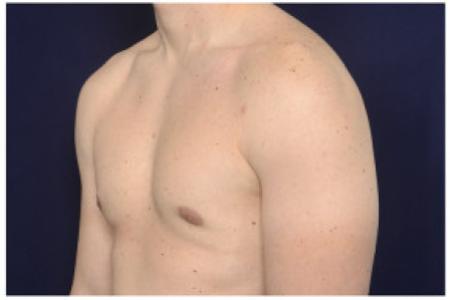 After image 2 Case #102351 - Gynecomastia