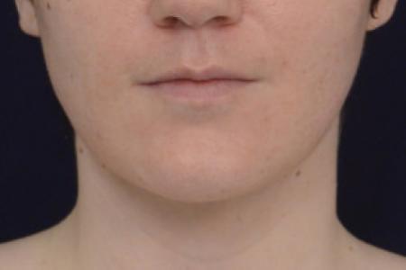 After image 1 Case #102801 - Neck Lift