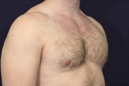 After image 2 Case #102386 - Gynecomastia