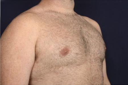 After image 2 Case #102481 - Gynecomastia