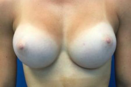 After image 1 Case #103326 - Silicone Breast Augmentation for a 27 year old female