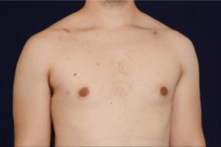 After image 2 Case #102681 - Gynecomastia