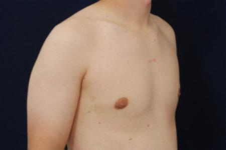 After image 2 Case #102656 - Gynecomastia