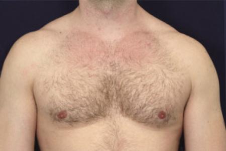 After image 1 Case #102386 - Gynecomastia