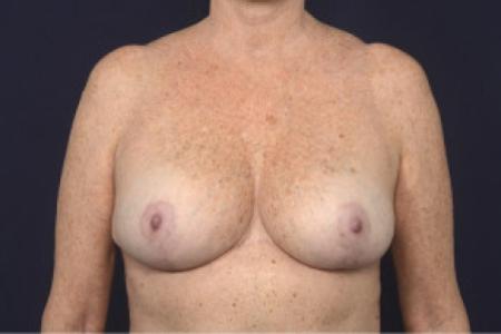 After image 1 Case #102391 - Breast Reduction
