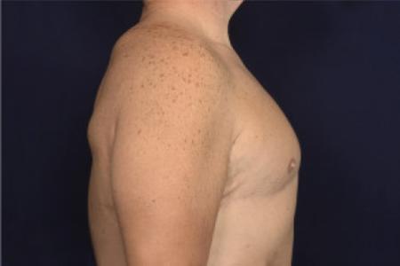 After image 3 Case #102431 - Gynecomastia