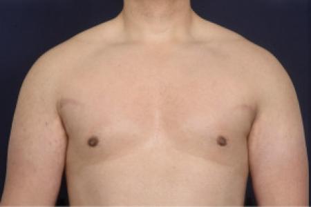 After image 1 Case #102526 - Gynecomastia