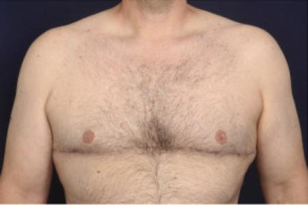 After image 1 Case #102426 - Gynecomastia