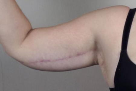 After image 1 Case #103136 - Upper Arm Lift 15