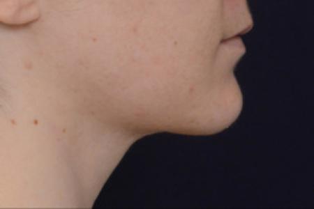 After image 3 Case #102801 - Neck Lift