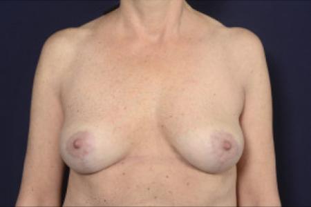 After image 1 Case #103091 - Fat Grafting of Breasts