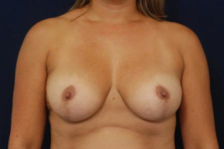 After image 1 Case #103086 - Breast Reduction