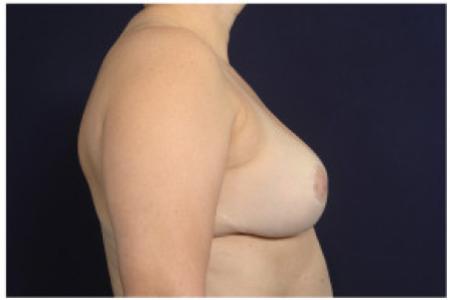 After image 3 Case #102341 - Breast Reduction