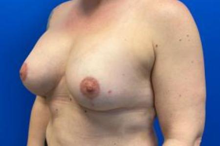 After image 2 Case #103276 - Silicone Breast Augmentation for a 38 year old female