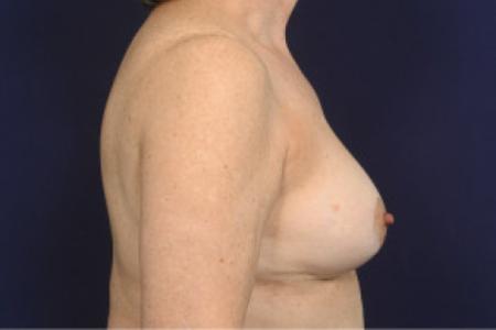 After image 3 Case #103106 - Fat Grafting of Breasts