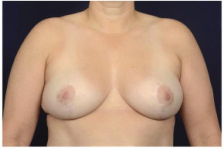 After image 1 Case #102341 - Breast Reduction