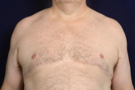After image 1 Case #102581 - Gynecomastia