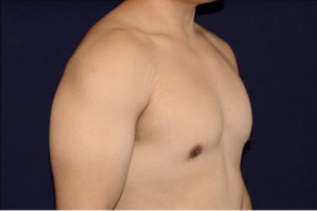 After image 2 Case #102731 - Gynecomastia