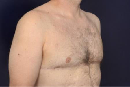 After image 2 Case #102426 - Gynecomastia