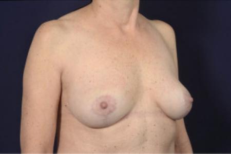 After image 2 Case #103091 - Fat Grafting of Breasts